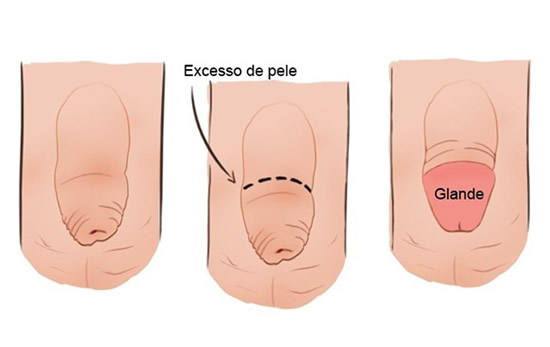 Clínica Uroderm, Cirurgia de Postectomia em Montes Claros, MG